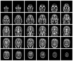 1 of the 12 Magnetic Resonance images series of a 67yo man.  MRI brain and brainstem: axial, coronal, and sagittal plane imaging with T1, T2, FLAIR, DWI, T2* sequences. Other images in the portfolio.