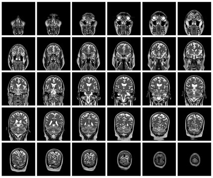 1 of the 12 Magnetic Resonance images series of a 67yo man.  MRI brain and brainstem: axial, coronal, and sagittal plane imaging with T1, T2, FLAIR, DWI, T2* sequences. Other images in the portfolio.
