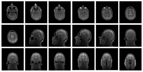 1 of the 12 Magnetic Resonance images series of a 67yo man.  MRI brain and brainstem: axial, coronal, and sagittal plane imaging with T1, T2, FLAIR, DWI, T2* sequences. Other images in the portfolio.