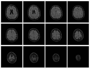 1 of the 12 Magnetic Resonance images series of a 67yo man.  MRI brain and brainstem: axial, coronal, and sagittal plane imaging with T1, T2, FLAIR, DWI, T2* sequences. Other images in the portfolio.
