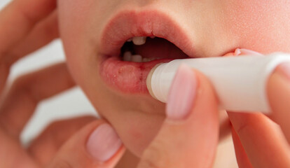 Mom applying lipstick to boy's dry lips