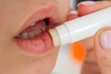 Mom applying lipstick to boy's dry lips