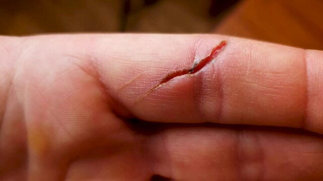 Cut on my finger. A crack on the skin of a finger, a deep wound. Injury on the finger.