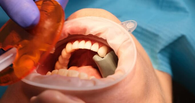 Skilled dentist uses ultraviolet light to harden tooth filling. Doctor directs ultraviolet light in oral cavity at newly placed composite material