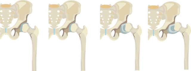 hartofilakidis classification is criteria to describe three types of developmental hip dysplasia