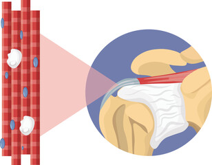 calcific tendinitis over shoulder vector 