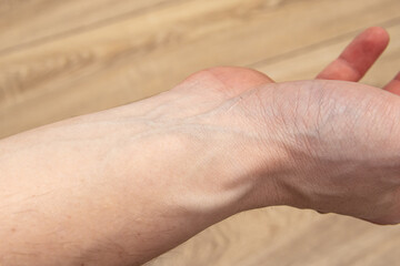 Protruding veins on a man's arm. Varicose veins on the hands