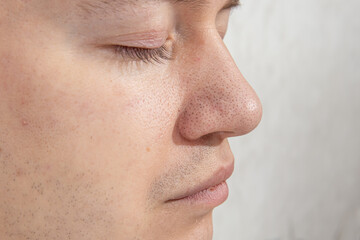 Enlarged pores and black dots on the nose. Problematic skin of a young man