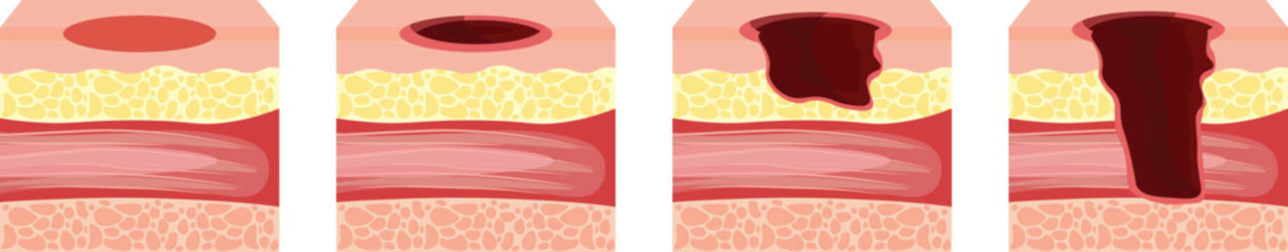 Pressure ulcers formation on bony parts of the body, such as the heels, elbows, hips and tailbone