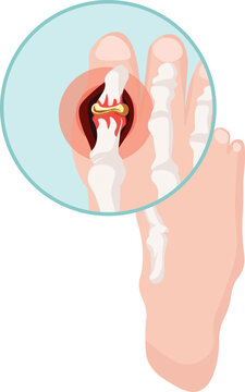 Gouty arthritis where flares happens over the joint causing pain 