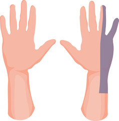 Wartenberg's Sign where there is slightly greater abduction of the fifth digit, due to weakness or paralysis of the adducting palmar interosseous muscle