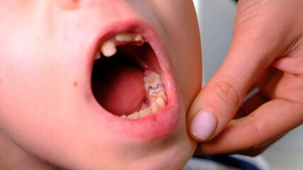 The child has bad teeth. Selective focus.