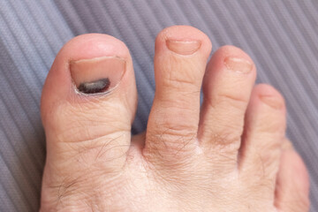 Subungual hematoma on the big toe, with a dark spot of blood under the nail, close-up