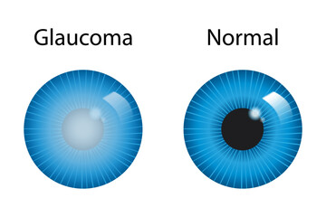 Glaucoma surgery concept. Procedures to reduce intraocular pressure to prevent vision loss. Human eye anatomy poster
