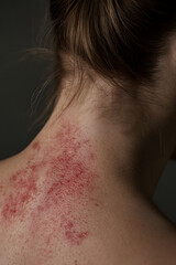 Naklejka premium Close-up of a person's neck and upper back with an irritated red rash, possibly due to allergies, skin conditions, or infection. A detailed medical and dermatology-related image. 