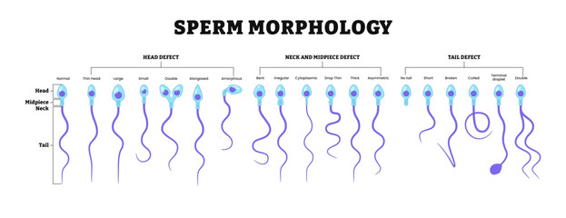 Different types of sperm morphology.  Normal, abnormal and defective human egg. Spermatozoon. Male Reproductive system. fertility diagram. Labeled head, midpiece, neck, tail defect.