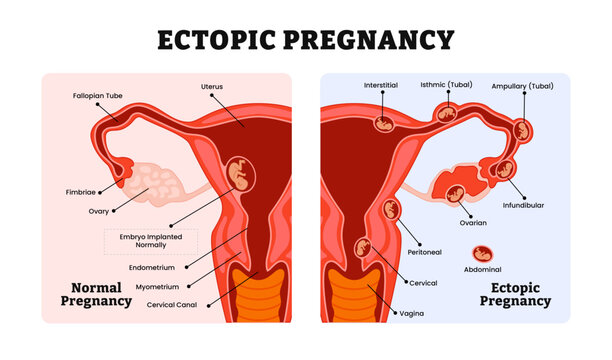 Ectopic Pregnancy or Tubal and Normal pregnancy medical diagram, labeled female reproductive system structure, embryo attachment locations, gynecological medical science educational.
