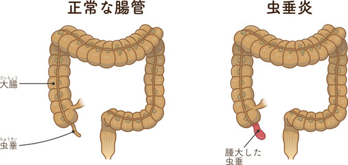 虫垂炎のイラスト appendiciti illustration