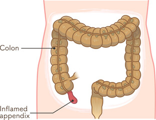 虫垂炎のイラスト appendiciti illustration