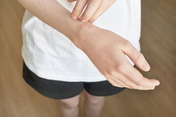 Close-up of skin with allergic skin disease with redness and itching on female wrist
