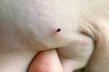 Bloated Ixodes ricinus tick digging into pink irritated skin, close-up, detailed texture