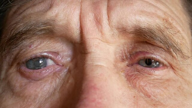  Viev of an old man with a cataract in his right eye.