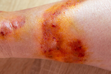 treatment and medicinal disinfection of damaged skin, healing wound from severe burn on leg adult...