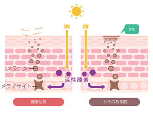 肌断面図で見せるシミのイラスト