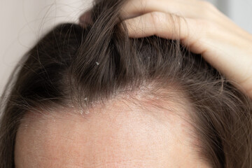 The woman found dandruff on her head. Closeup dandruff flakes on the scalp.