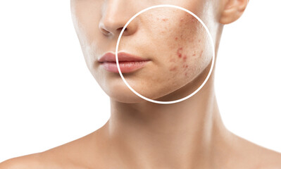 A young girl with a problem skin. Photo before and after treatment for acne.