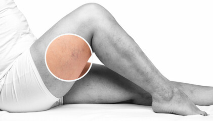 Removal of varicose veins on the legs. Medical inspection and treatment of Telangiectasia. Phlebeurysm.