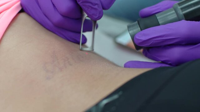 Girl erasing tattoo of exboyfriend name, deleting or removing. Dermatologist clinic tatto erase professionaly.