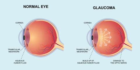 normal eye vs glaucoma vector design