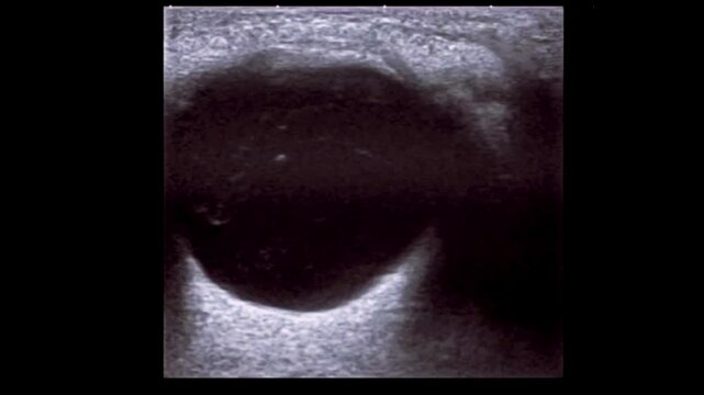 ectopia lentis ,dislocated lens of the eyem lens dislocation ultrasound	