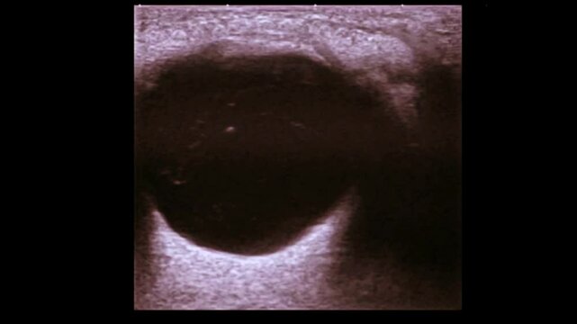 ectopia lentis ,dislocated lens of the eyem lens dislocation ultrasound	