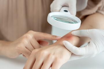 skin problem and beauty of asian girl. Dermatologist use magnifying glass look itchy skin from skin allergic, steroid allergy, sensitive skin, chemical allergy, rash, insect bites, Dermatitis.