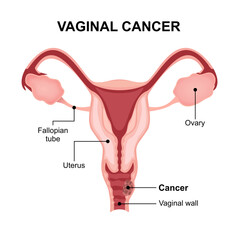 Vaginal Cancer Medical Illustration Female