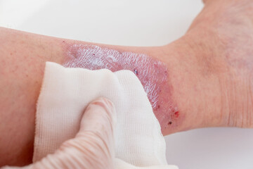doctor applies ointment to wound from on lower leg with scars adult female patient, redness, sores...