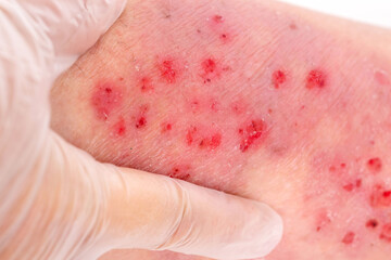 doctor treats large healing wound from on lower leg with scars adult female patient, redness, sores...