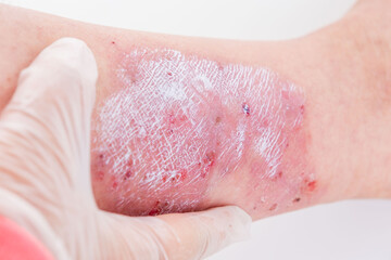 doctor applies ointment to wound from on lower leg with scars adult female patient, redness, sores...