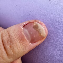 Fingernail Showing Health Condition