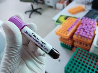 Blood samples for HbA1c (Hemoglobin A1c). Diabetic treatment monitoring in the laboratory...