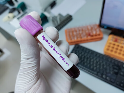 Doctor hold Blood sample for Myelodysplastic Syndrome test. Medical testing concept with laboratory background.
