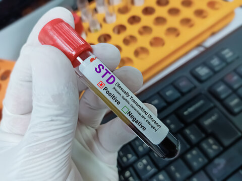 Doctor hold Blood sample for STD (Sexually Transmitted Disease ) Test. Positive result test tube.