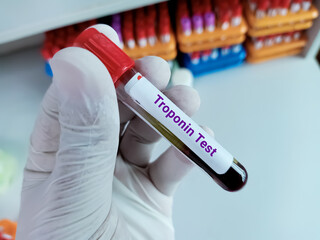Scientist hold blood sample for ALP or Troponin test, diagnosis for cardiovascular disease....