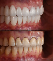emax ceramic veneers