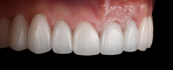 Obraz premium emax ceramic veneers