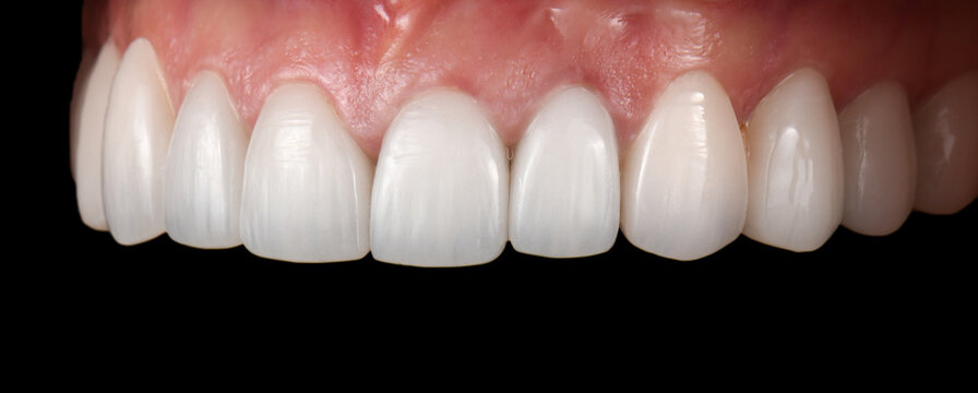 emax ceramic veneers