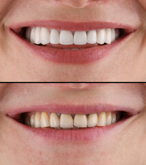 emax ceramic veneers