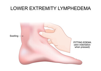 Lower extremity lymphedema